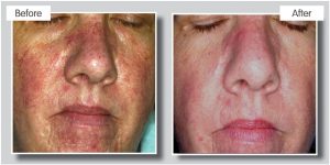 rosacea laser treatments top laser clinic Birmingham