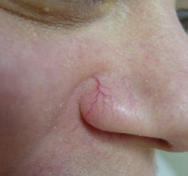 Thread Vein Removal Birmingham Thread Vein Removal Birmingham